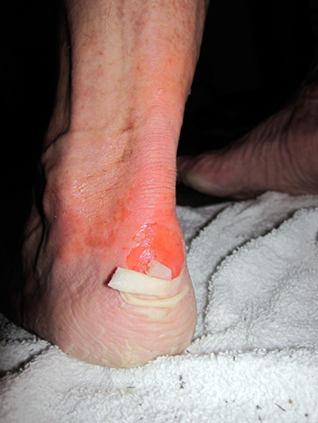heel blister