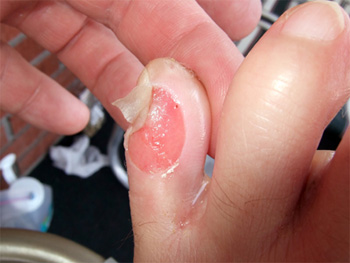 hiking blister